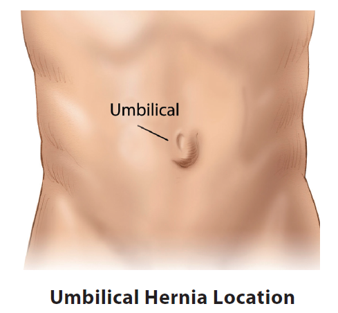 Hernia Surgery